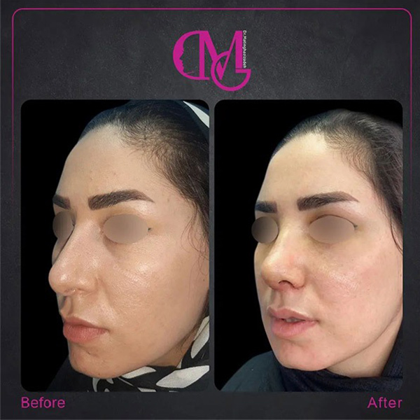 جراحی بینی گوشتی - دکتر متین قاضی زاده