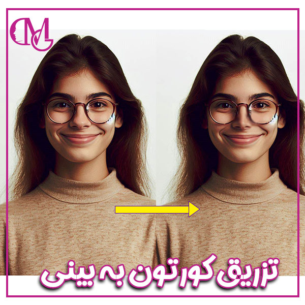 تزریق کورتون به بینی + دکتر متین قاضی زاده